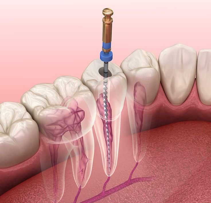 root canal near me