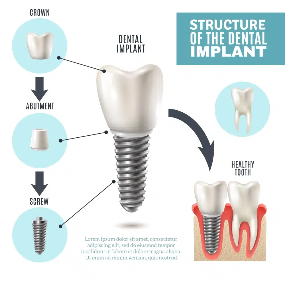 Dental implants vancouver