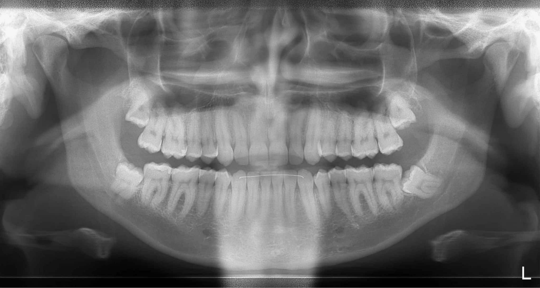 Bc Tooth Pin Pain-Free Tooth Extraction in Vancouver BC - Willow Dental Care Vancouver
