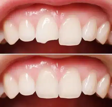 teeth bonding before after