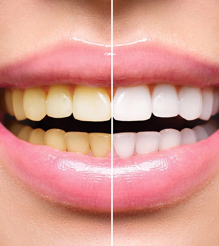 teeth whitening before after