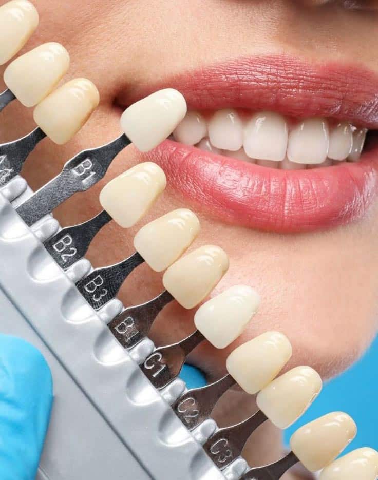 dental veneers near me