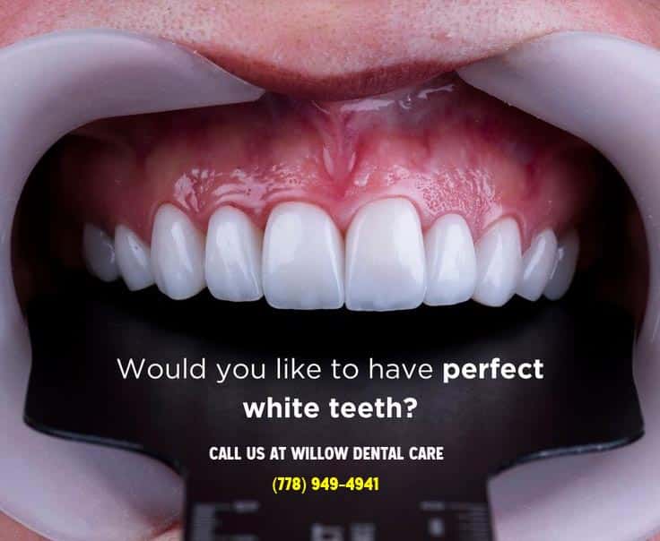 teeth whitening vancouver