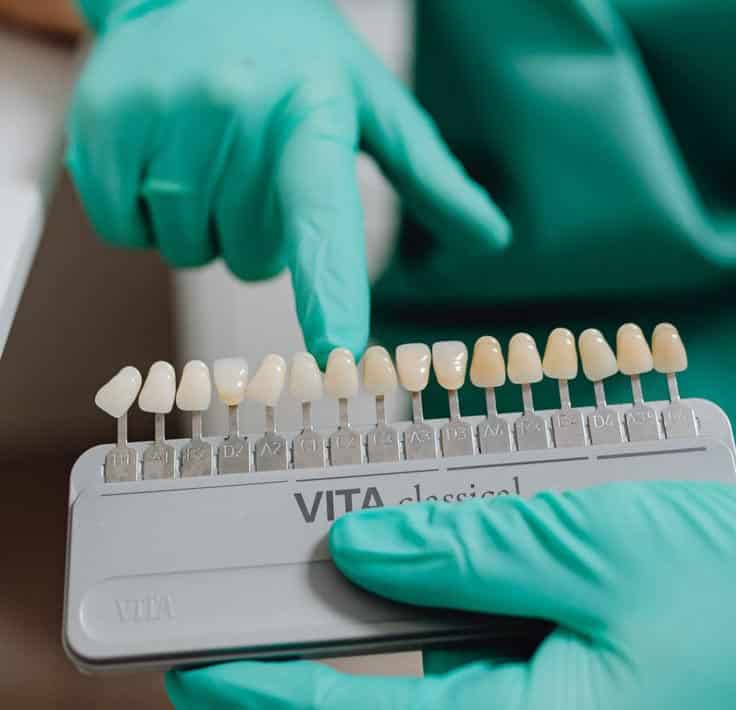 veneers vancouver
