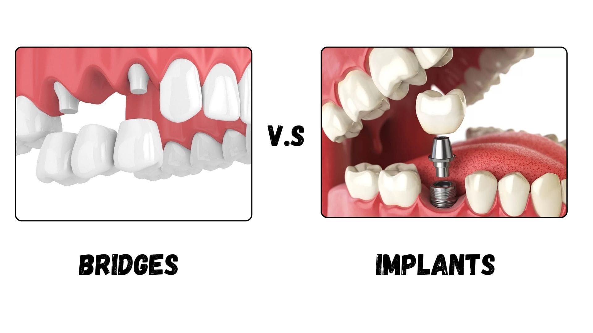 Bridges vs. Implants: Which Dental Solution Is Right for You? - Willow ...