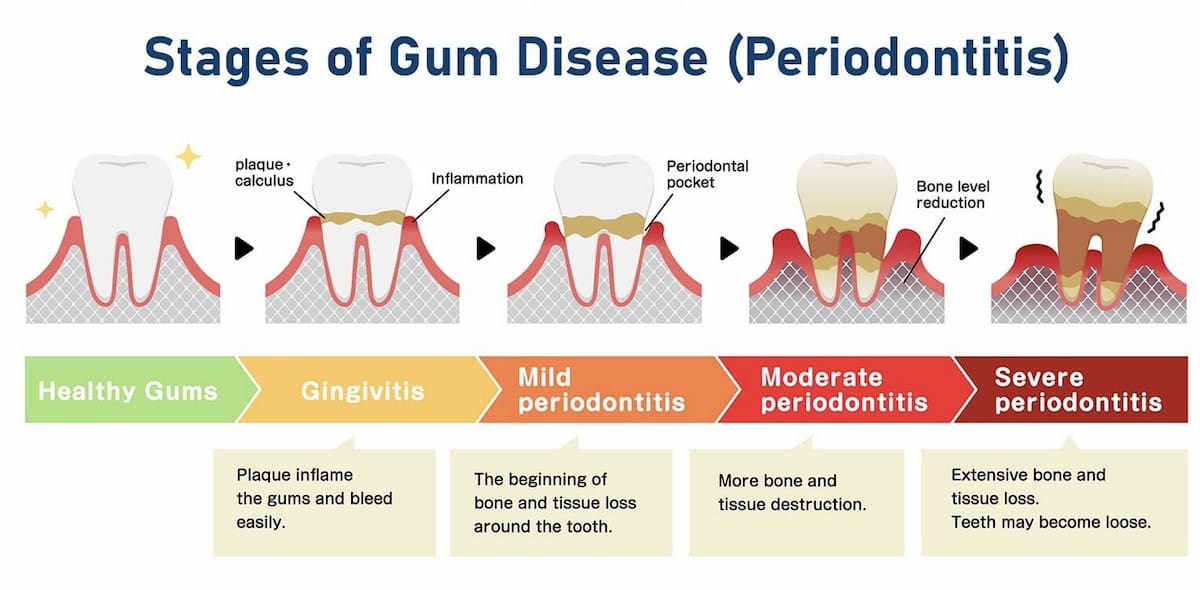 stages of gum disease