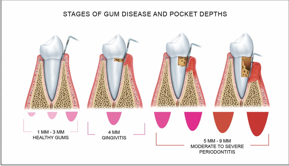 stages of gum disease and