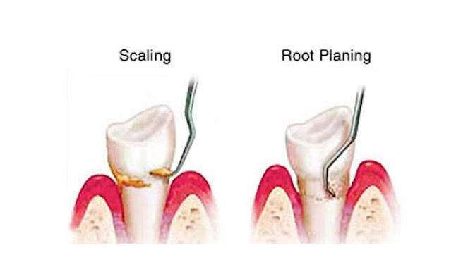 Periodontal Maintenance