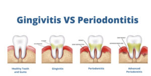 gingivitis vs periodontitis