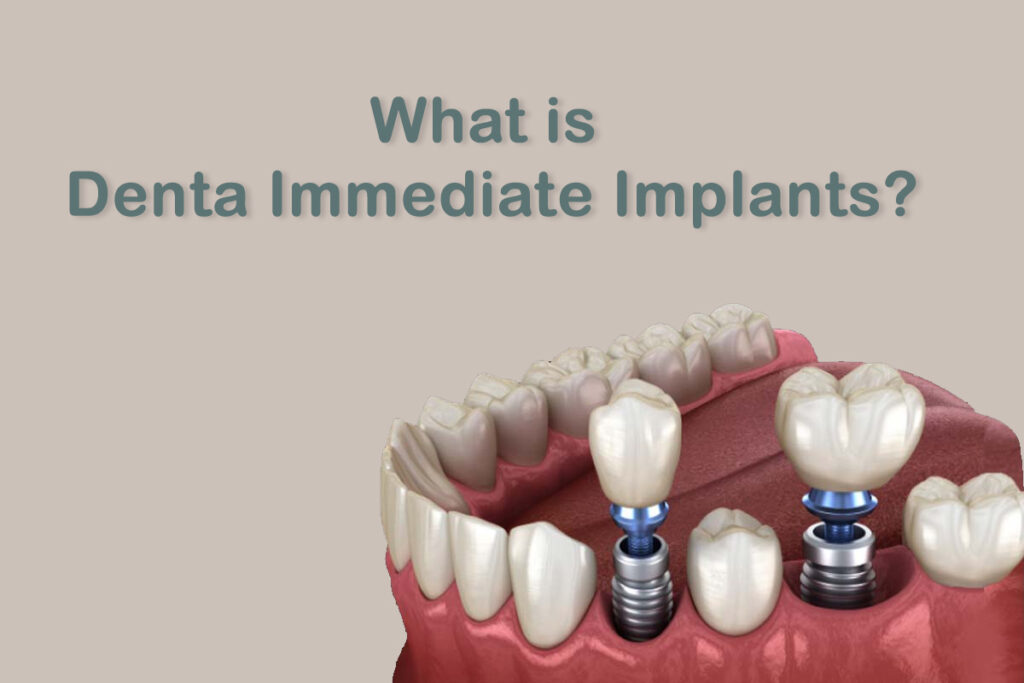 immediate dental implants