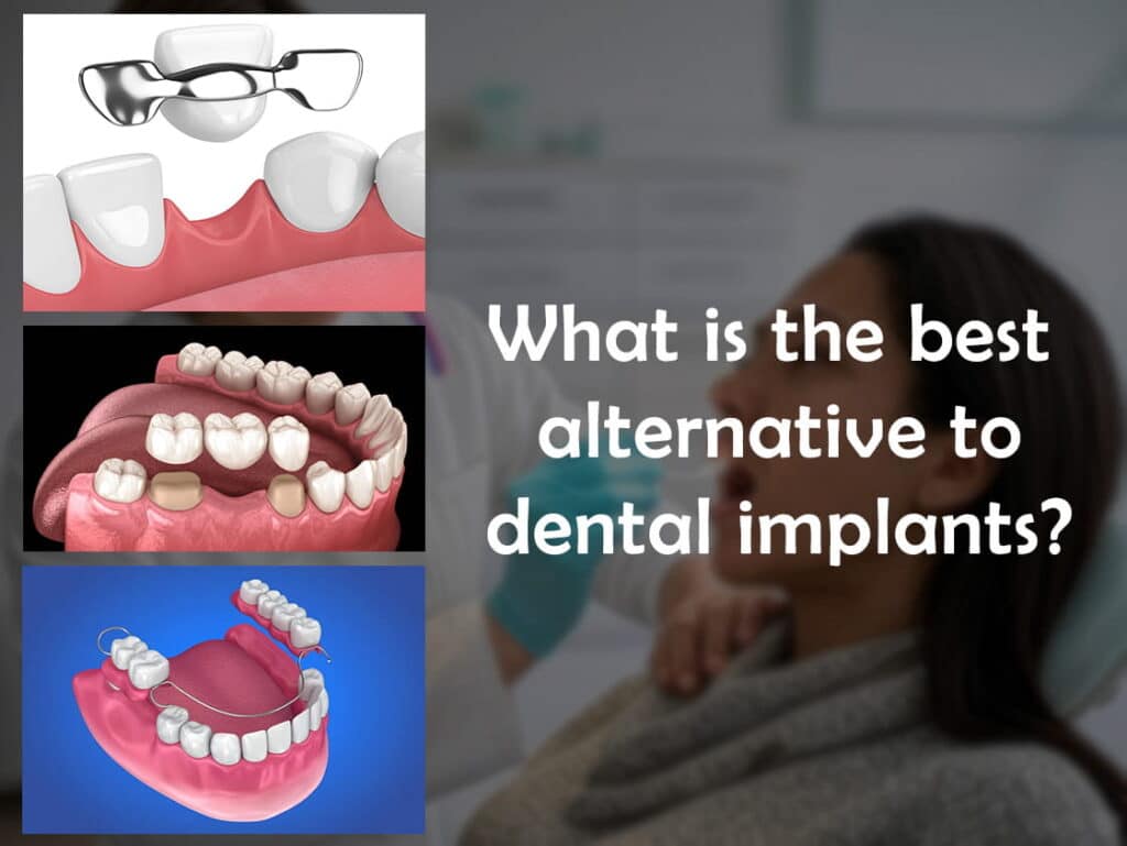 What is the best alternative to dental implants?