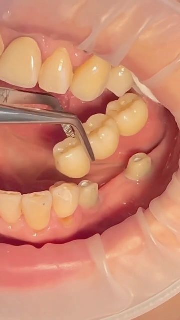 What Are Dental Bridges?