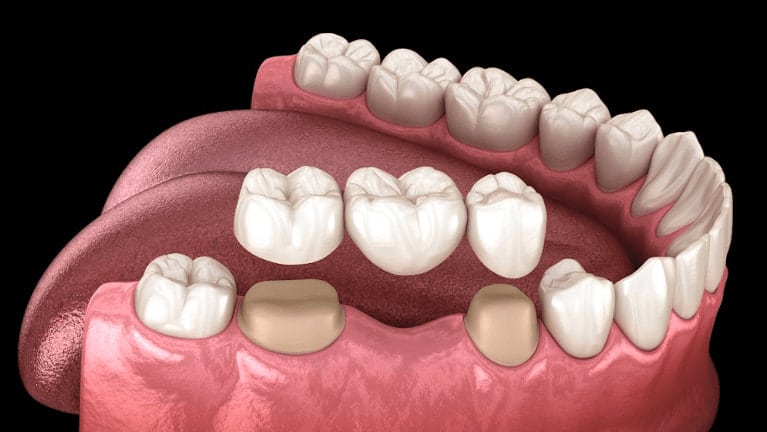 dental bridge