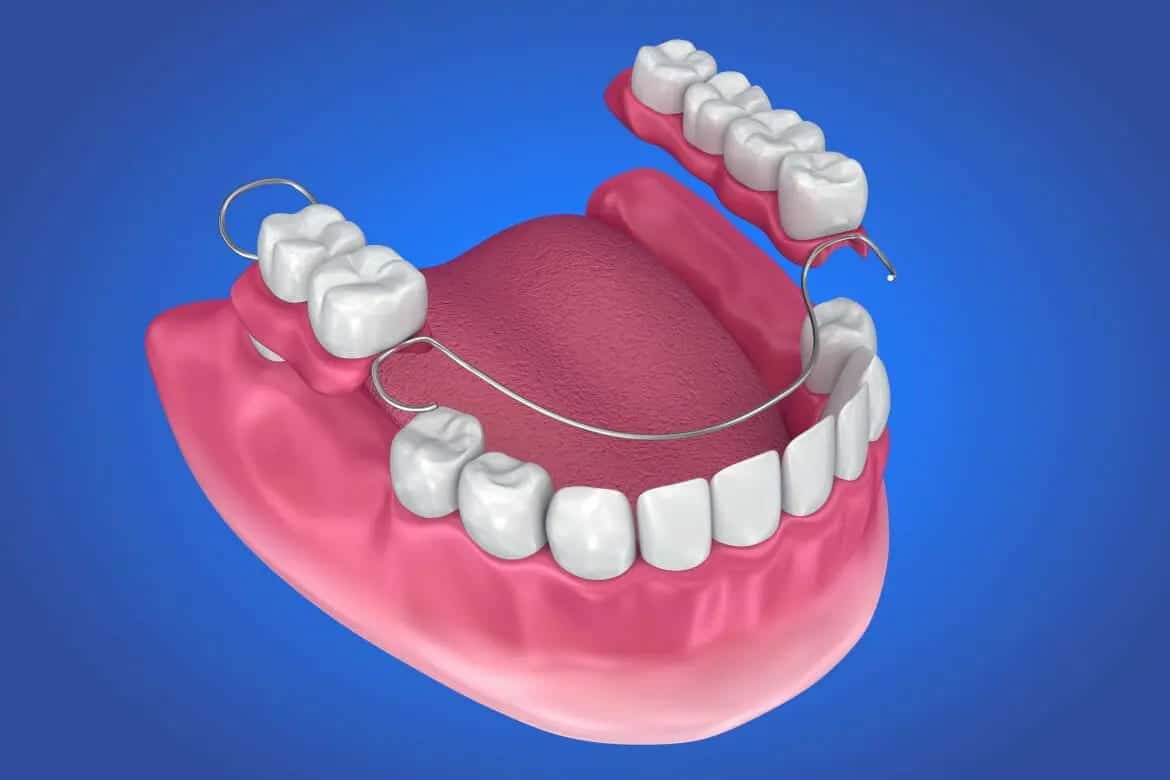 Partial Dentures