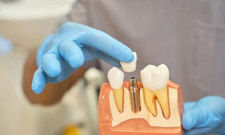 Which Type of Dental Implants Is Right For Your Teeth?