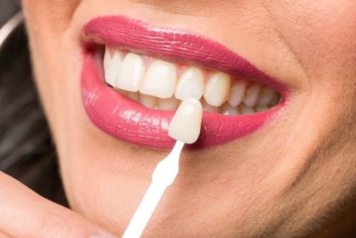 What Are The Most Affordable Types of Dental Veneers?