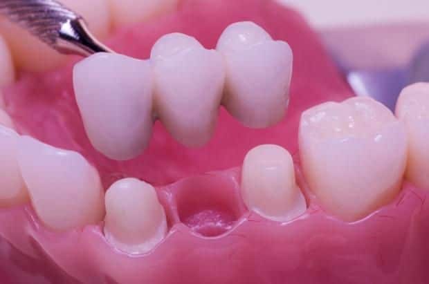 How Much is The Cost of Dental Bridge?