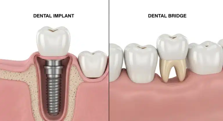 Dental Implants vs Dental Bridges