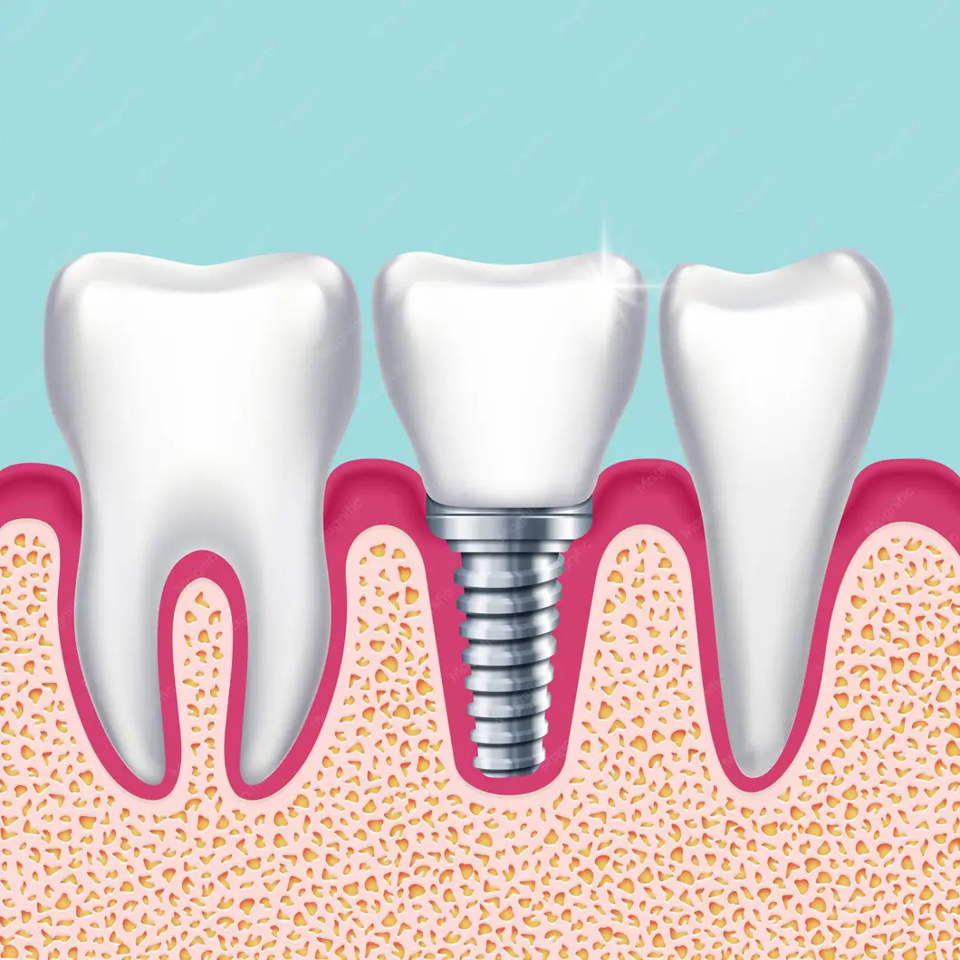 Implant Lifespan
