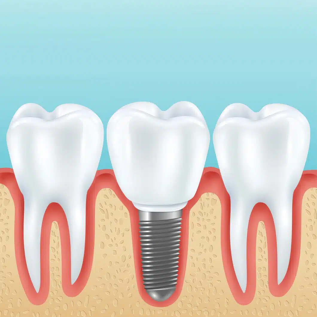 Tooth Implant Insurance