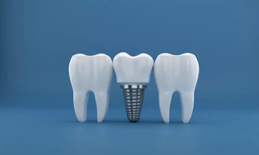 Dental Implants