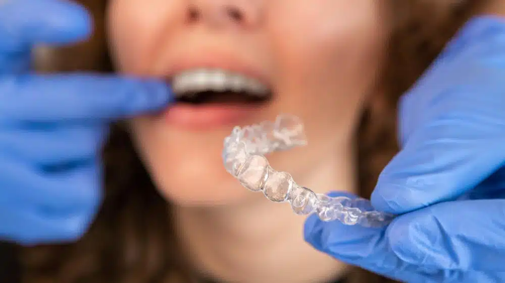 Average Invisalign treatment times